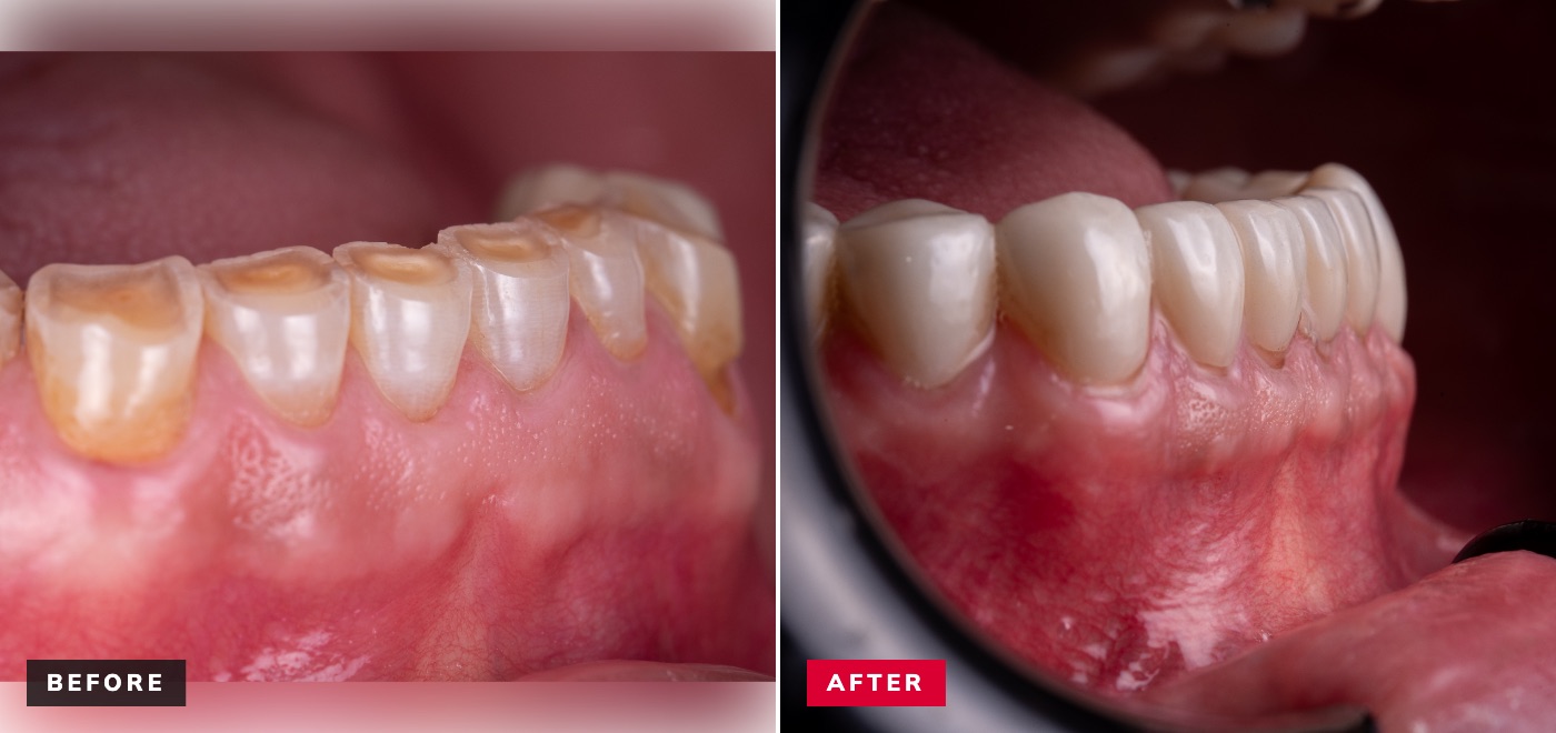 Crown lengthening before and after — worn lower teeth restored with full crowns after surgical crown lengthening