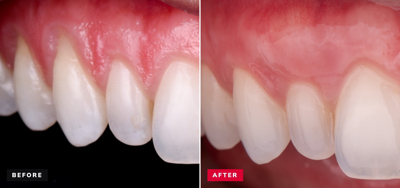 Gum grafting before and after — recession covered with a natural gumline