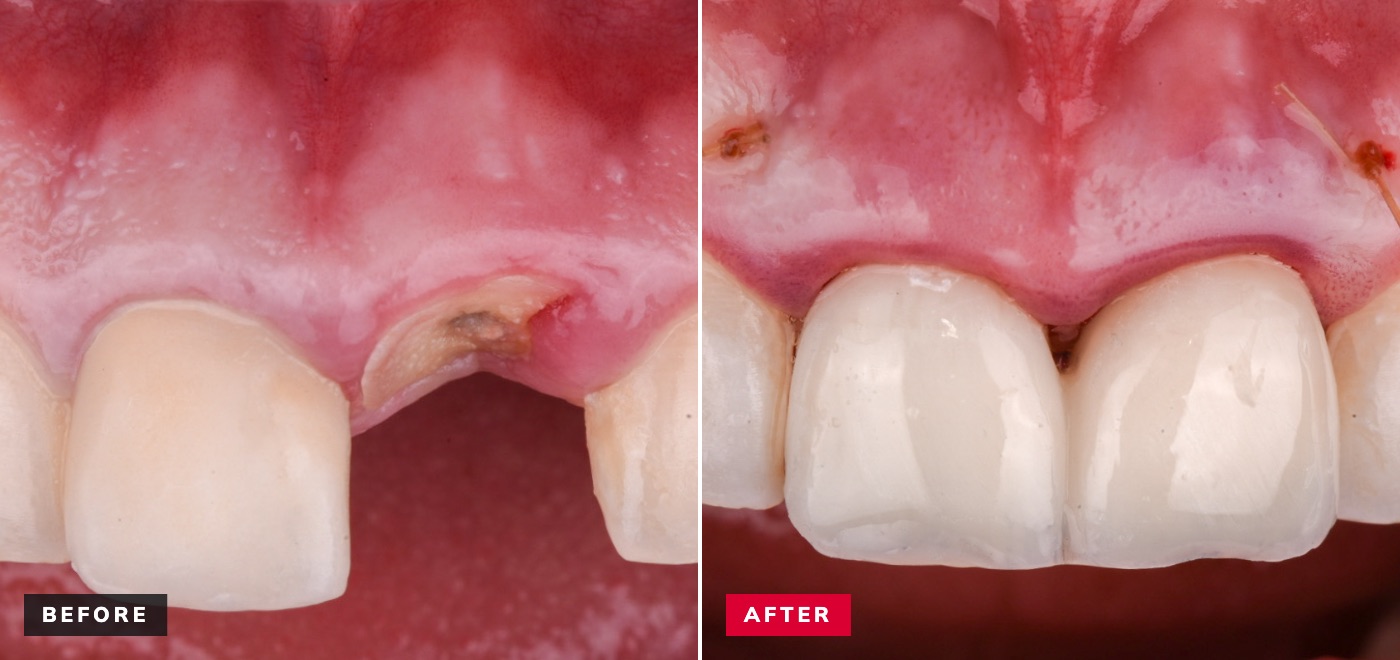 Immediate implant before and after — fractured front tooth restored with implant crown