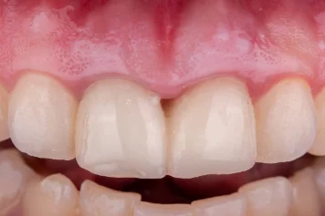 After treatment — clinical photo