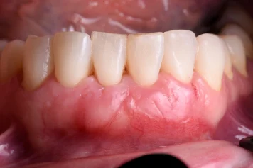 After treatment — clinical photo