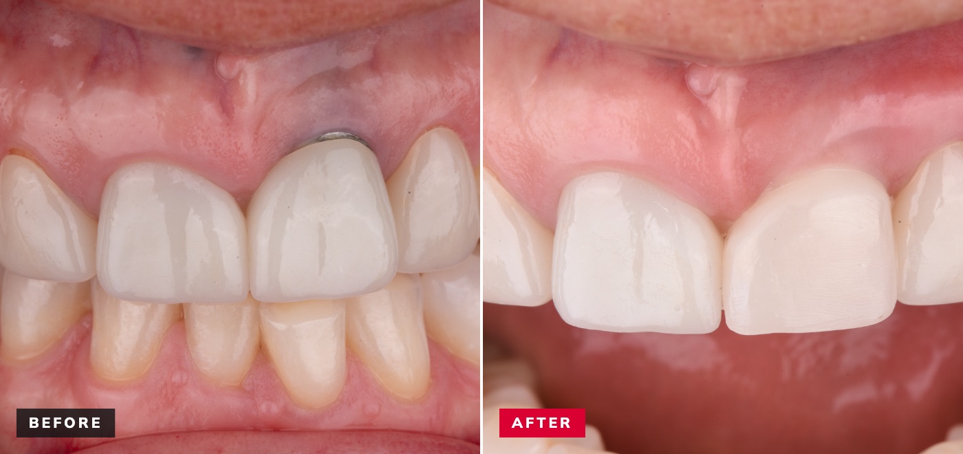 Esthetic complication before and after — exposed implant metal margin replaced with a natural gumline and crown