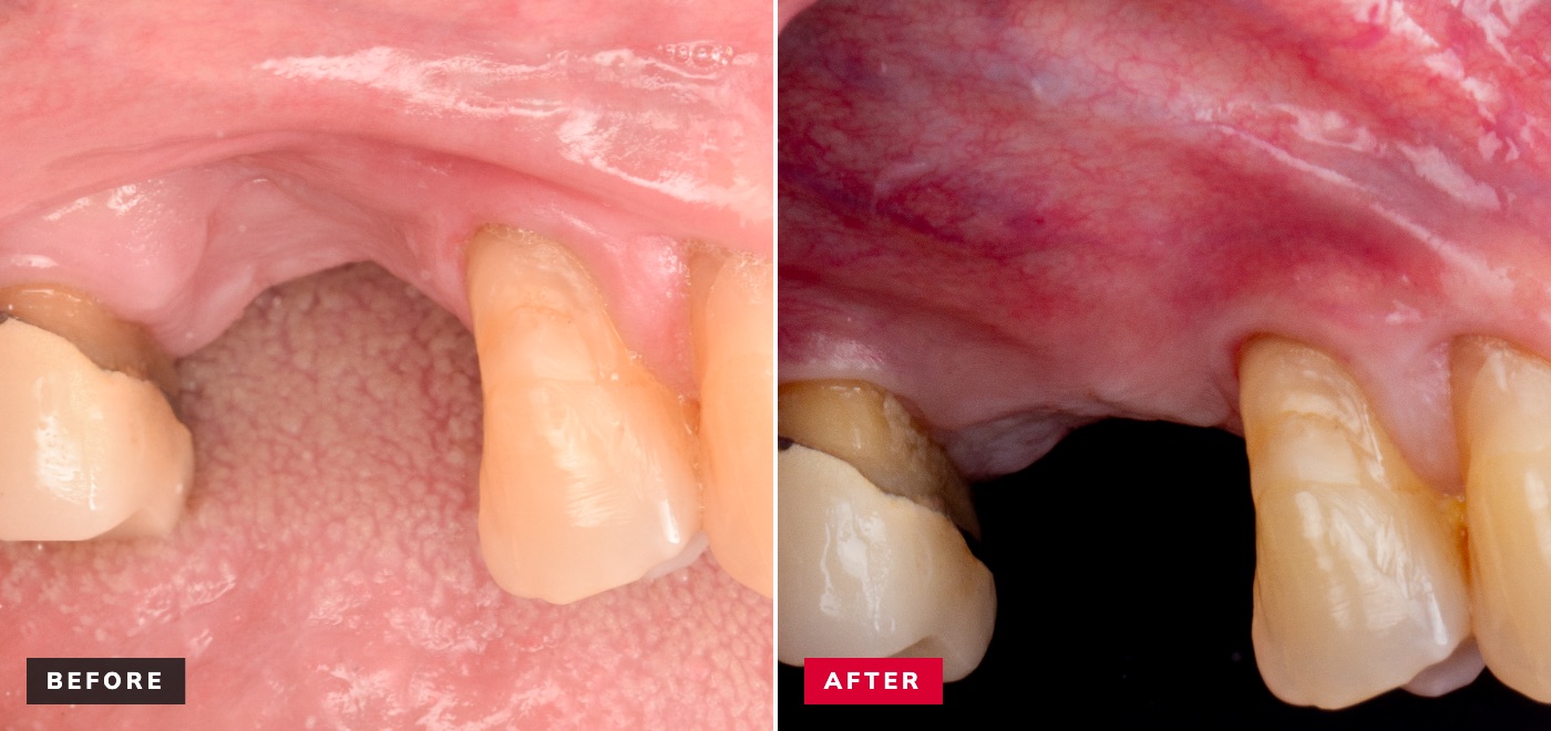 Bone regeneration before and after — collapsed ridge rebuilt for implant placement